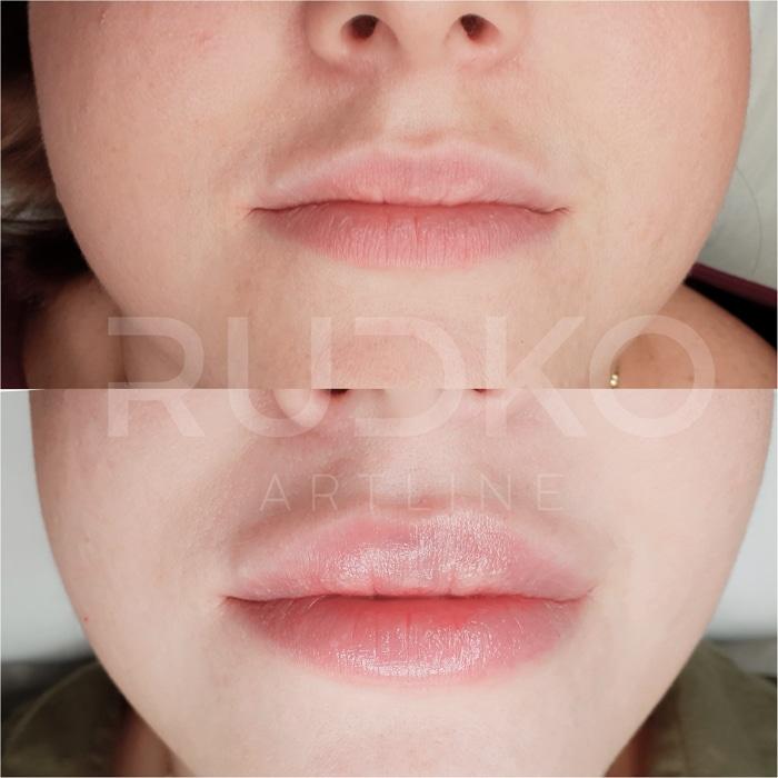 филлеры до и после фото киев губы